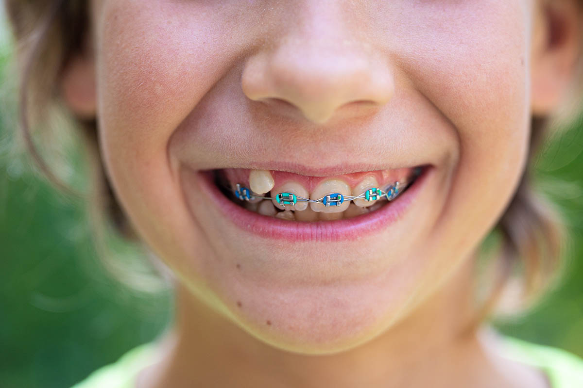 green colored braces