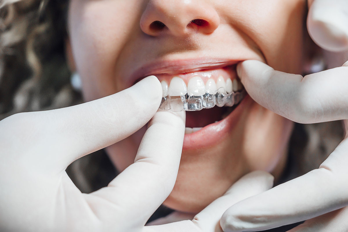 How does Invisalign Lite work?