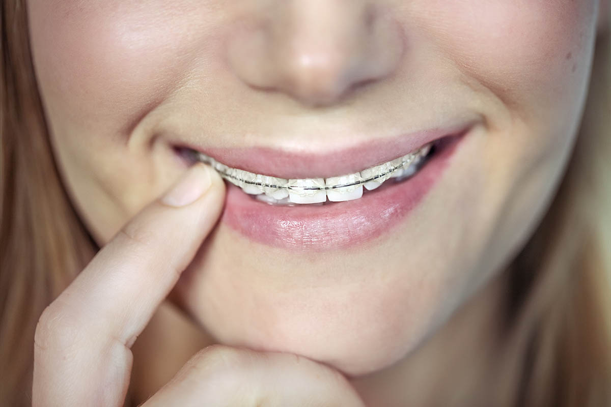 teenager wearing braces for teeth straightening teenager wearing braces for teeth straightening