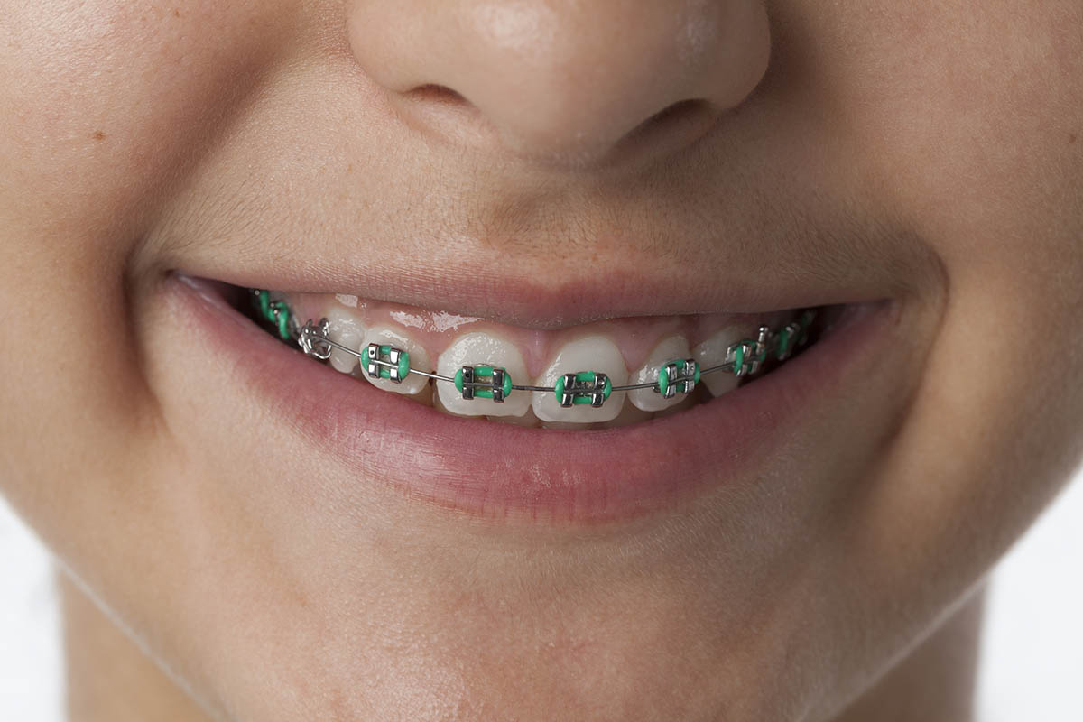 green colored braces