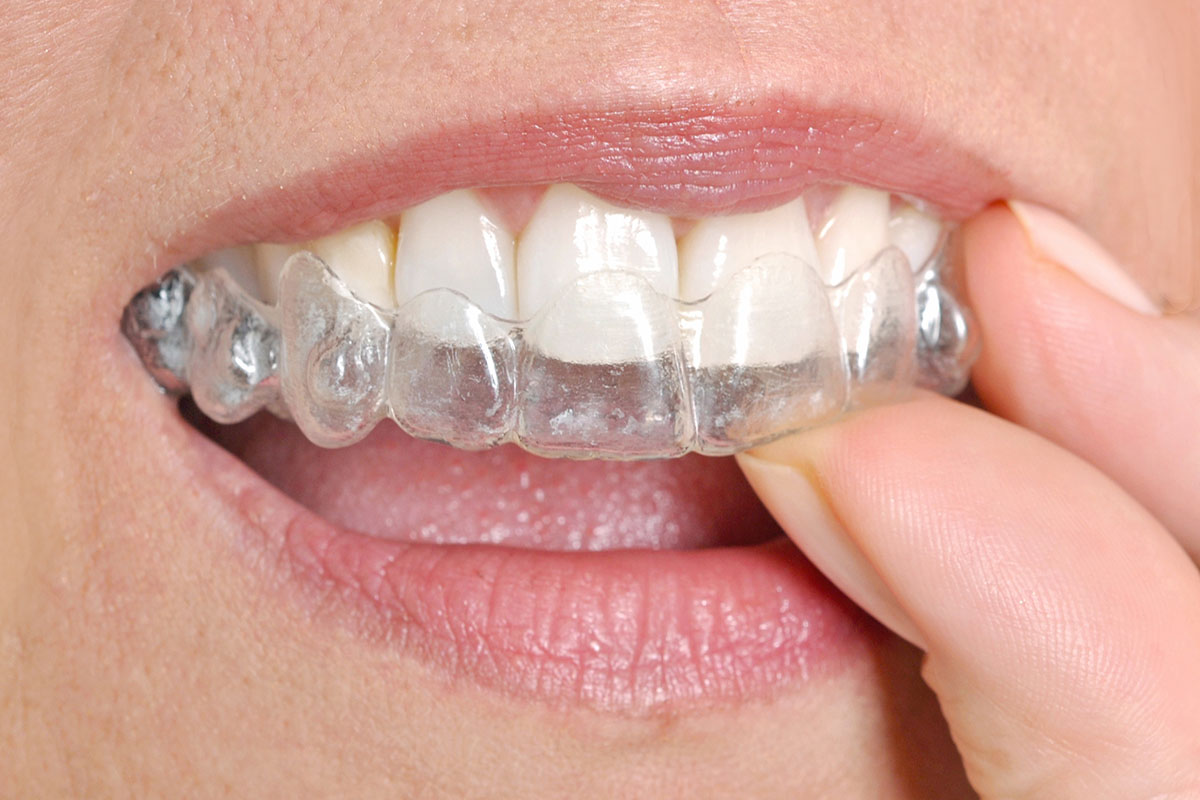woman putting on invisalign aligners