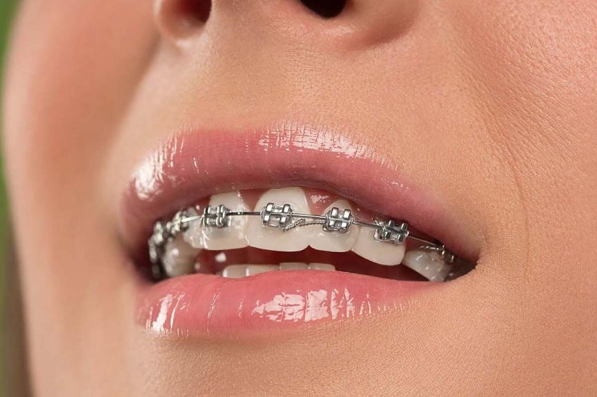 Beautiful young woman with metal teeth braces Beautiful young woman with metal teeth braces