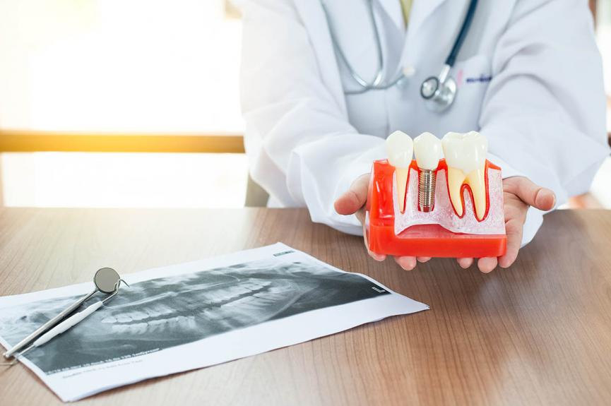 dentist holding dental implant model dentist holding dental implant model