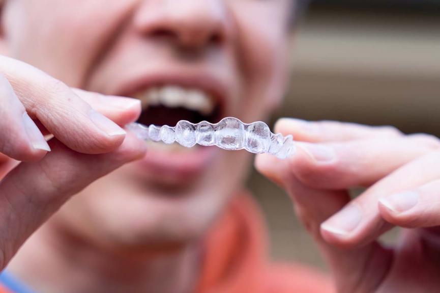 invisalign aligners invisalign aligners