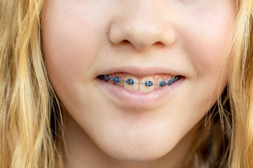 braces color ideas for girls