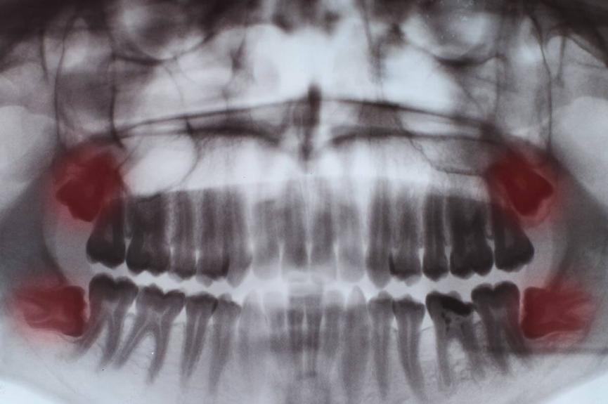 wisdom teeth x-ray wisdom teeth x-ray