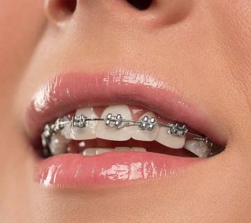 Beautiful young woman with metal teeth braces