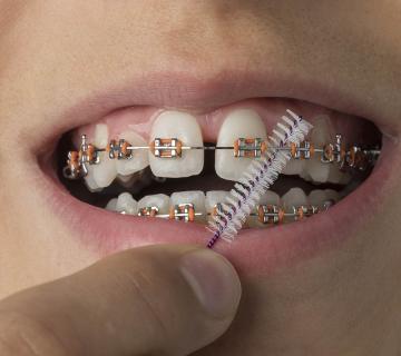 close up of metal braces treating diastema gap teeth