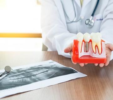 dentist holding dental implant model