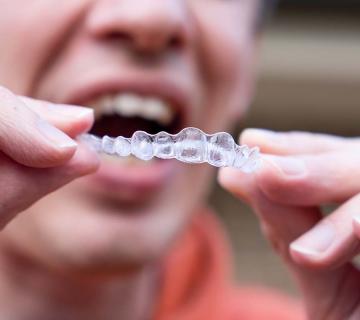 invisalign aligners