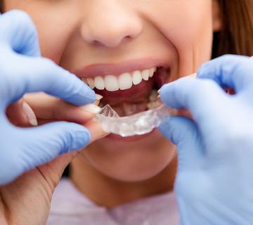 woman putting on invisible teeth aligners