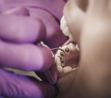 dentist checking patient's lingual braces