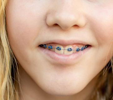 teenage girl with colored dental braces
