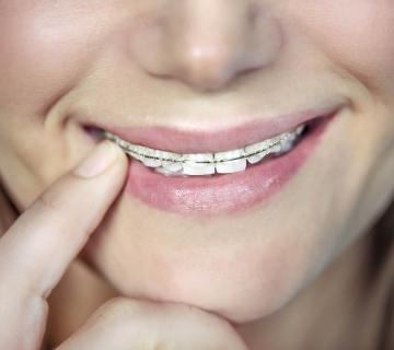 teenager wearing braces for teeth straightening
