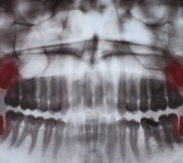 wisdom teeth x-ray