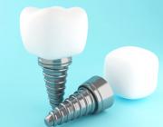 photo of dental implants photo of dental implants