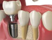 Image of dental implant Image of dental implant