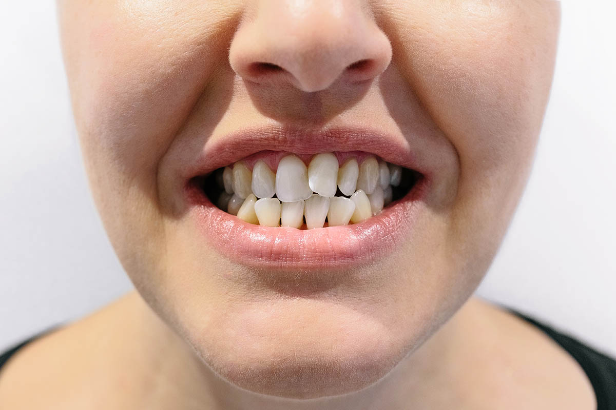 close up photo of woman with dental crowding / misaligned teeth