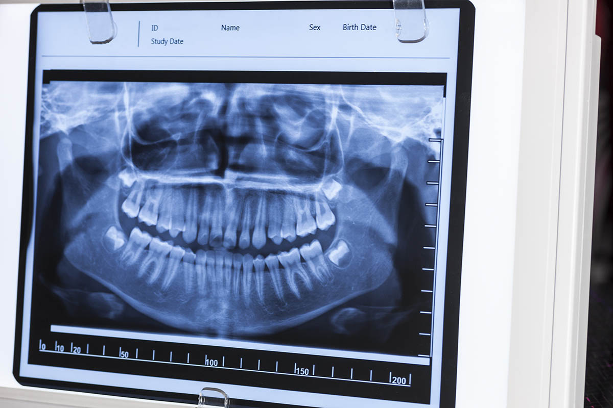 size of dental panorama x ray film